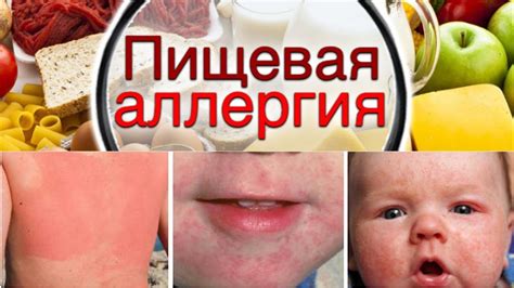 Аллергическая реакция на продукты питания или лекарства