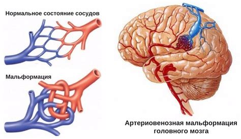 Артериовенозная мальформация: симптомы и диагностика