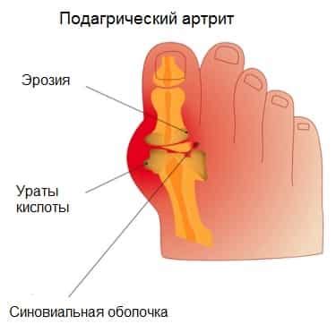 Артрит и бурсит: как связаны эти заболевания с шишками