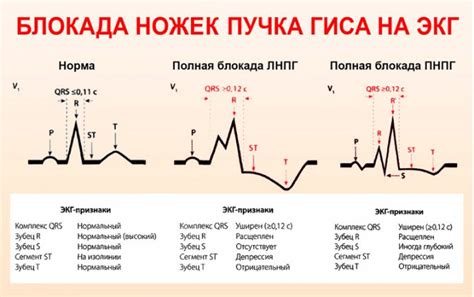 Блокада ножек и пучка гиса