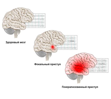 Виды эпилептических приступов