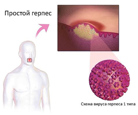 Вирус простого герпеса