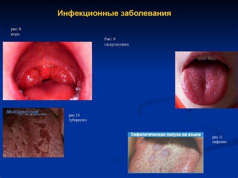 Влияние заболеваний полости рта на слюновыделение