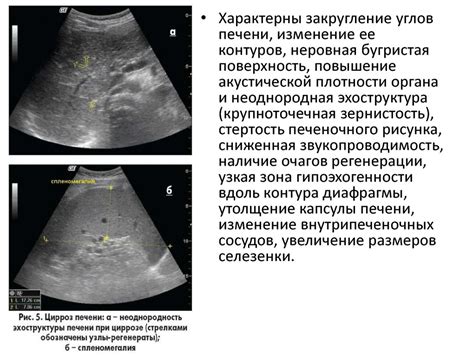 Влияние повышенной эхогенности паренхимы на здоровье