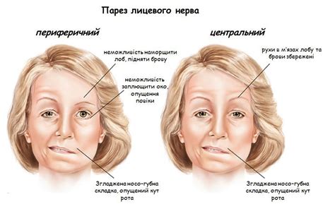 Влияющие факторы на развитие пареза лицевого нерва