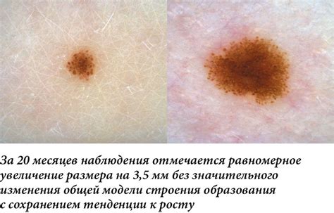 Внутридермальный меланоцитарный невус: основные аспекты изучения и лечения