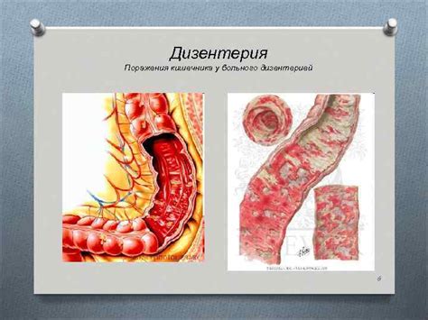 Возможность поражения кишечника