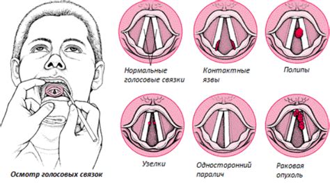 Возможные заболевания гортани и голосовых связок