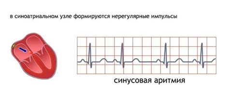 Возможные осложнения синусовой аритмии у детей