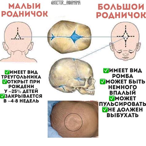 Возможные последствия маленького родничка