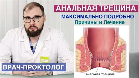 Возможные причины трещины в анусе