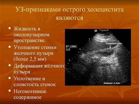 Возможные причины утолщения стенок желчного пузыря