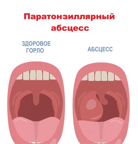 Воспаление гланд: эффективные способы лечения