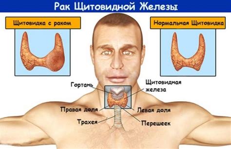 Воспаление или инфекция щитовидки