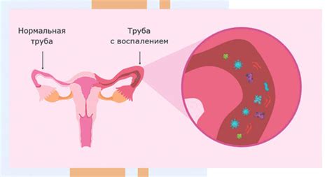 Воспаление маточных труб: последствия и возможное удаление