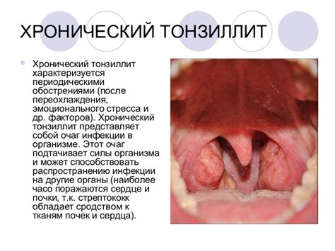 Воспаление миндалин: симптомы, причины и способы лечения