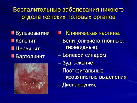 Воспалительные заболевания половых органов