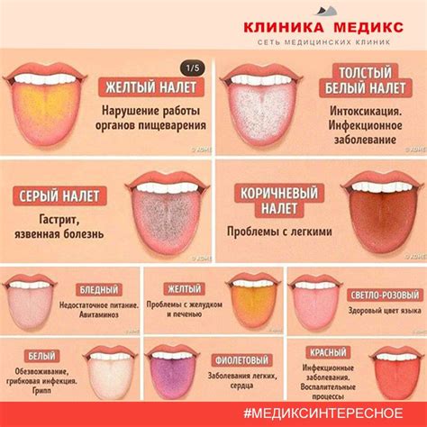 Вредные причины налета на языке