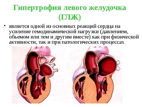 Вторая часть. Причины и факторы риска гипертрофии левого желудочка