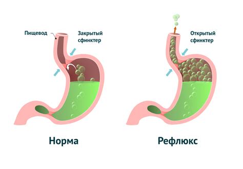 Газообразование в кишечнике