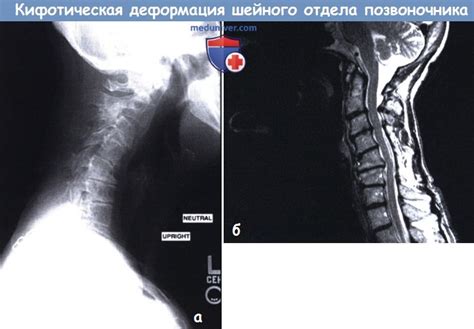 Генетические причины кифотической установки шейного отдела позвоночника