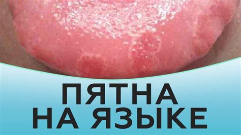 Гигиена и питание: влияние на прыщи на языке