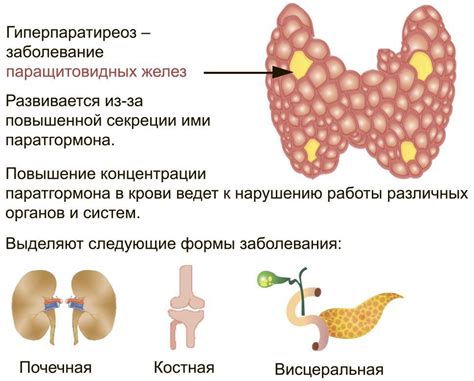 Гиперпаратиреоз у женщин - определение и признаки