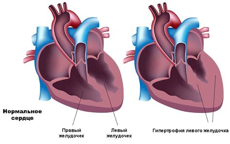 Гипертрофия левого желудочка: что это такое?