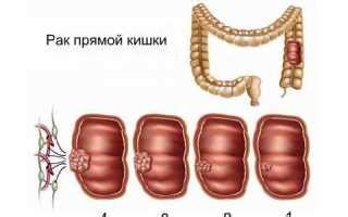 Главные причины движения в анусе: от геморроя до болезней кишечника