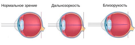 Глаза с разными степенями близорукости и дальнозоркости