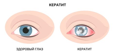 Глазные болезни и инфекции