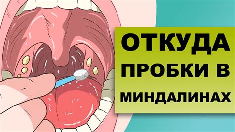 Гнойные отложения на миндалинах: причины и методы удаления