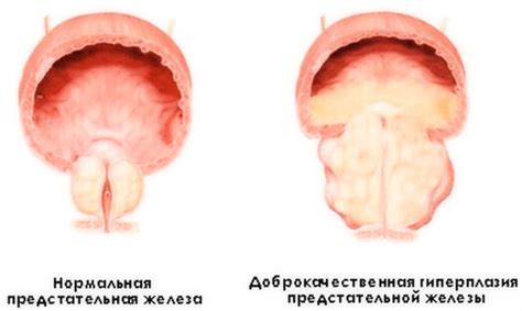 ДГПЖ предстательной железы: что это? Все, что нужно знать