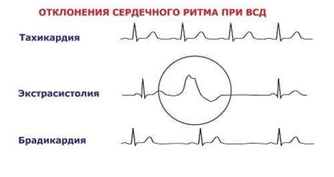 Диагностика ВСД по кардиальному типу