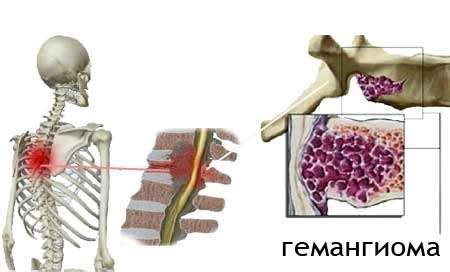 Диагностика гемангиомы Th9 позвонка