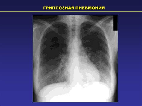 Диагностика гипостатических изменений в легких