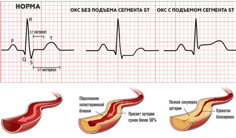 Диагностика и лечение ОКС