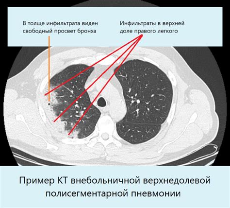 Диагностика и лечение дегенеративных изменений глубоких легких