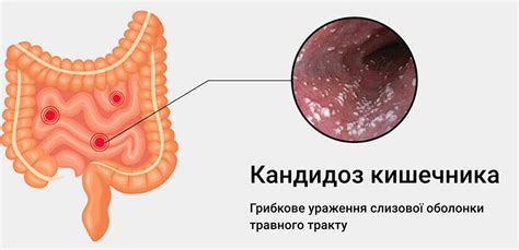 Диагностика и лечение дрожжей в кале у взрослых