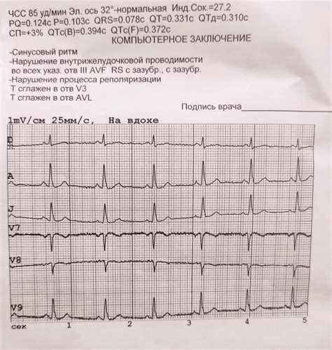 Диагностика и лечение нарушения внутрижелудочковой проводимости на ЭКГ у взрослых