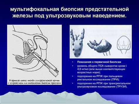 Диагностика и лечение структурных изменений предстательной железы