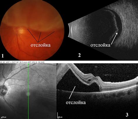 Диагностика отслоения сетчатки