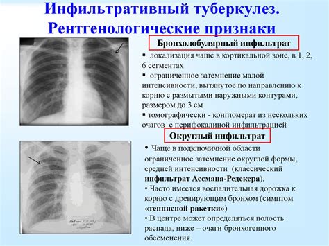 Диагностика очаговых изменений в легких на КТ: методы и процедуры