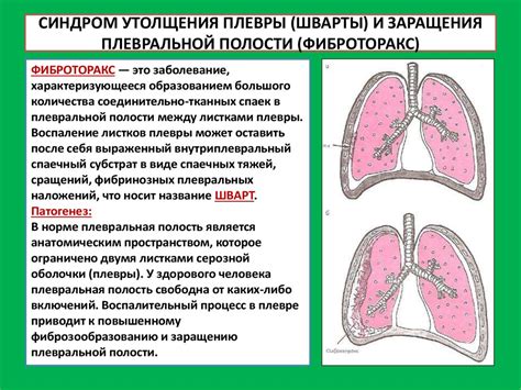 Диагностика плевральной шварты