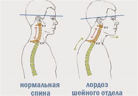 Диагностика сглаженного лордоза