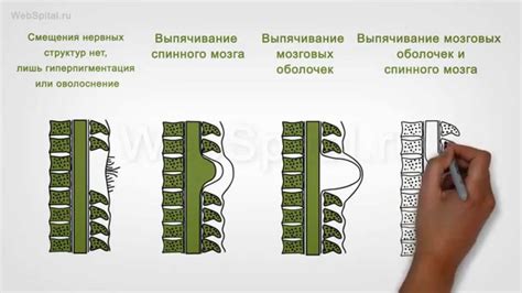 Диагностика спины бифиды у детей