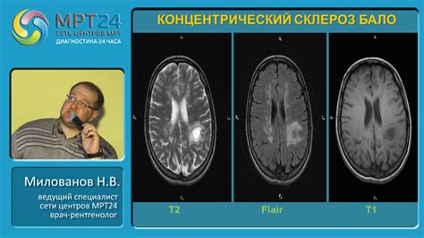 Диагностика субатрофии головного мозга