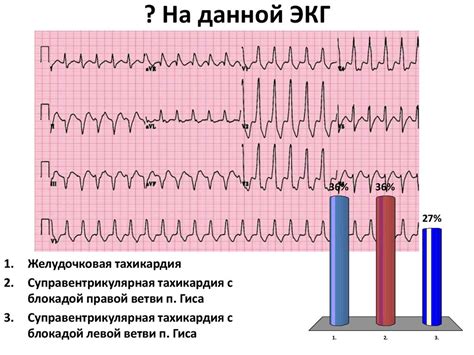 Дифференциальный диагноз ВПС-синдрома на ЭКГ