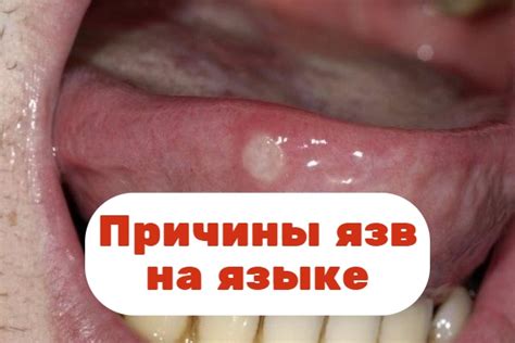 Документированные методы лечения язв на языке