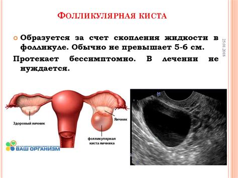 Доминирующий фолликул правого яичника: основные моменты